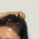 류헤어라인 - 북구 | 여자모발이식후기 앞 헤어라인 시술 전후 1개월 차