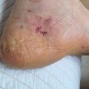 연세마디힘재활의학과의원 | [활성화 PRP 치료] 2회차, 3회차.