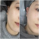 메스메디칼 | 부산 연산동 블랙헤드 여드름 모공관리 리제이에스테틱 추천 👃🏻