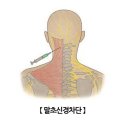 암성 통증 환자의 말초신경 차단술 Peripheral nerve block 이미지