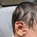 다산약국 | 다산 아이앤힐 성형외과 신생아 스킨텍 제거 후기