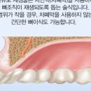 제니스치과 네이버블로그