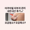 NO.1 자동차피부과 | 부평 아쿠아필 피부과 피부관리 모공 피지 블랙헤드 제거 솔직 후기