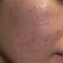 해피부과의원 | 내돈내산 치료, 여드름 지옥 4개월 탈출 후기 ‘해피부과’. 여드름으로 아픈 사람들 한 번만 보고...