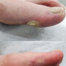 파나슈 뷰티 | 걸음걸이로 인한 굳은살 관리, 티눈 관리 후기 확실한 관리를 원한다면 파나슈 뷰티에요
