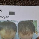 국제두피탈모