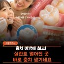 덴포라 | 어릴 때 한 "충치예방 실란트" 언제까지 유지될까? 성인이 되어서도 다시 한 후기