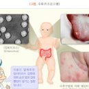 수족구병 증상 원인 잠복기 전염 치료 소아 유아 수족구병 전염 치료 수두와 차이점 이미지