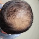 아쥬반 | [탈모관리 5개월차] 아쥬반 카스이 두피케어 후기｜사진 비교 공개