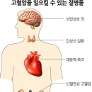 고혈압 hypertension 이미지