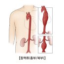 복부대동맥류(Abdominal aortic Aneurysm) 이미지