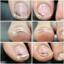 허뤼업체형교정전문 | 부산 부암동 내성발톱 교정 후기 ｜걸을 때마다 발가락 콕콕 "나이스케어"
