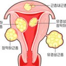 자궁근종 원인과 증상 통증 수술 치료 방법 이미지