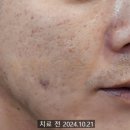 [부산 하단역 셀렉트피부과] 제대로 된 여드름 흉터 치료 1회 리얼 후기