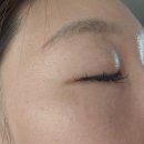 메디셀 | 2024.11.03 미간주름패치 (메디셀 헤르덤 쥬넬라 리페어 패치)