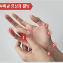 종일 키보드 치고 톡 날리는 당신, 컵들 때 손목 찌릿하면 이 증상 이미지