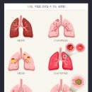 결핵진단비보장 특별약관[무배당 알파Plus보장보험2302] 이미지