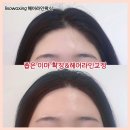 리쏘왁싱 | 좁은이마 확장 전문 리쏘왁싱! 자연스러운 확장 전후 후기들