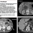 Pancreatic Pseudocyst 이미지