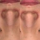 아이스박스월영점 | 부평 피부관리 월영에스테틱 슈퍼젝션 관리 후기