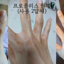 프로폴리스로 한포진 완치 이미지