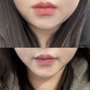 창원 이중턱 지방분해주사 [시티세븐 7층 한의원] 윤곽약침 1회차 후기