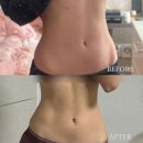 닥터로피부과의원 | 닥터손유나의원 매직복부캣 강남 지방분해주사 1회차 솔직후기