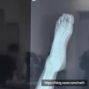 우리정형외과 | 유아 발등 통증 원인, 발 삐끗했을때(정형외과 진료후기)