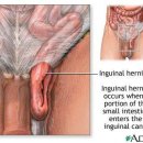 The Client with an Inguinal Hernia 이미지
