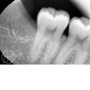 보스톤청플란트치과의원 | 사랑니 발치, 왜 미루지 말아야 할까요? 의정부보스톤치과