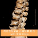 척추[요추1번, 요추 2번 압박골절]골절 근재보험 합의[보상]은 어떻게? 이미지