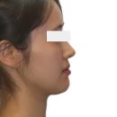 국제모아치과의원 | 양악 부작용 2배 낮추는 성인 주걱턱 교정