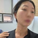 편사와의 전쟁 목 듀오덤 알러지.. 얼굴, 목 편평사마귀 제거 후기(당일~7일차 경과 사진)