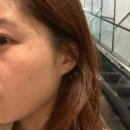 서면한의원 | 서면 편평사마귀제거, 화접몽한의원 후기