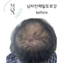 북리미용실 | 고덕탈모치료전문 청북두피문신 평택두피페인팅 남자탈모 여자탈모 헤어라인 두피문신유지기간 두피...