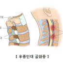 목뒤 통증 목뒤 결림 경추부 후종인대 골화증 이미지