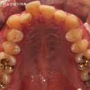 40대 교정 부작용, 잇몸이 더 약해질까요? 안산본오동치과