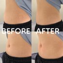 코어한의원 | 강남역 다이어트 한의원 복부 리바이브 &amp; 코어스컬프 효과와 후기