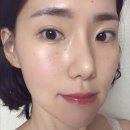 산소의원 | 신사 프레쉬홍닥터의원｜줄기세포 피부 주사 고압산소케어 솔직 후기 (1주 경과)