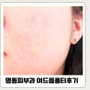 SRS | 내돈내산 명동역피부과 여드름흉터시술 SRS레이저 한달후기