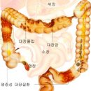 대장질환개요 이미지