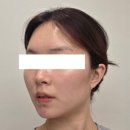 5후 | 내돈내산 스컬트라 3회차(총 5바이알) 6개월 후 찐 후기, 비싼 돈 대비 효과는 없는 것 같기도..