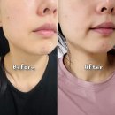 진정 | 여드름 스팟 크림 밀포드 트러블 진정 효과 후기