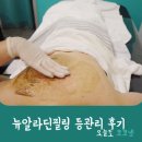 동대문밀리오레관리단 | 극한체험후기.. 등드름/등여드름 뉴알라딘필링으로 죽다살아났다. 동대문피부관리 스킨컬쳐 후기
