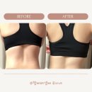 이오메디칼 | 청담비만클리닉 운동해도 안 빠지는 등살, 이오팻으로 1회 만에 변화후기