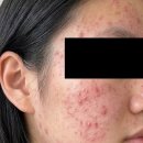 약국 여드름약 압출후 남은 흉터까지 사라진 케어법 추천