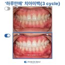 스마일온치과의원 | [공지] 건대 스마일온서울 치과, 광진구 치아미백 사례모음 및 실제 후기