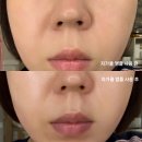 팔자주름없애기 홈케어, 큐어토리 자가큘 회춘 앰플 1주 후기
