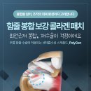 의료법인구암의료재단 시티병원 | 회전근개 봉합, '보강'까지 생각한다면 — 연조직 지지체 폴리젠(PolyGen) 알아보기