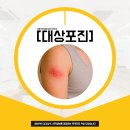 도곡타워정형외과의원 | 도곡역정형외과 면역력이 뚫렸을 때 다시 찾아오는 대상포진